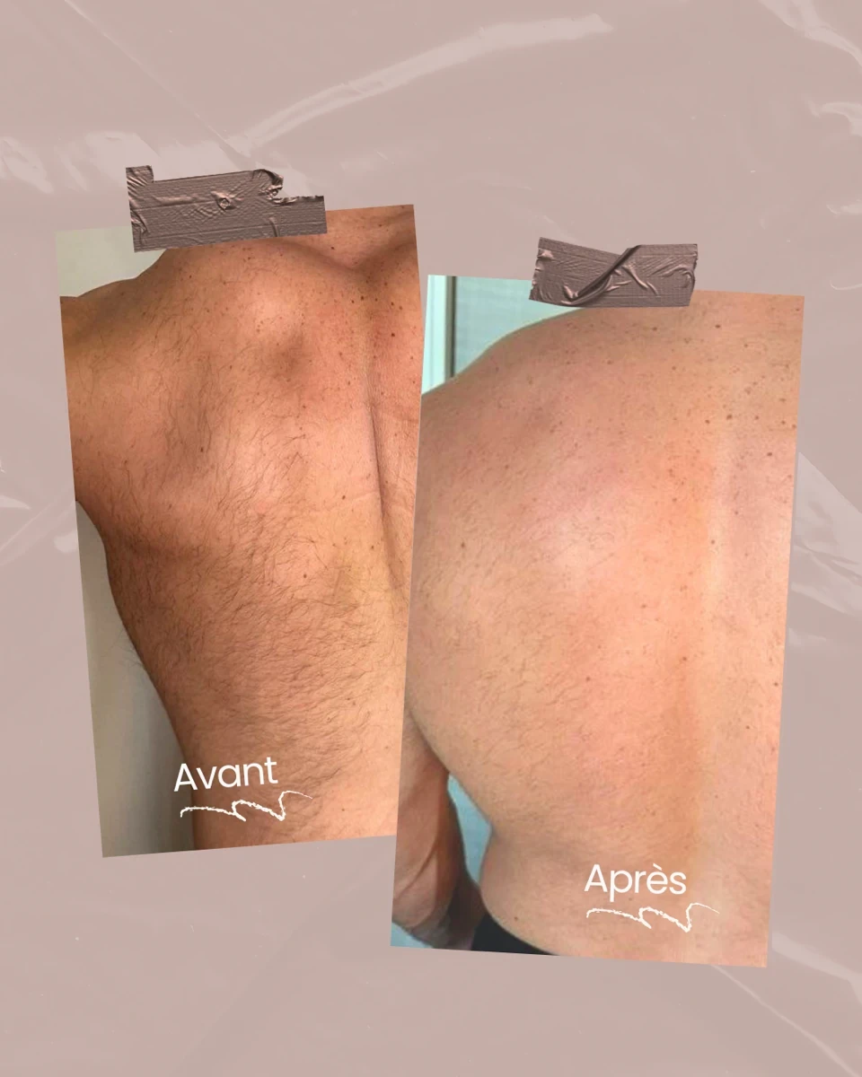 Epilation laser du dos homme