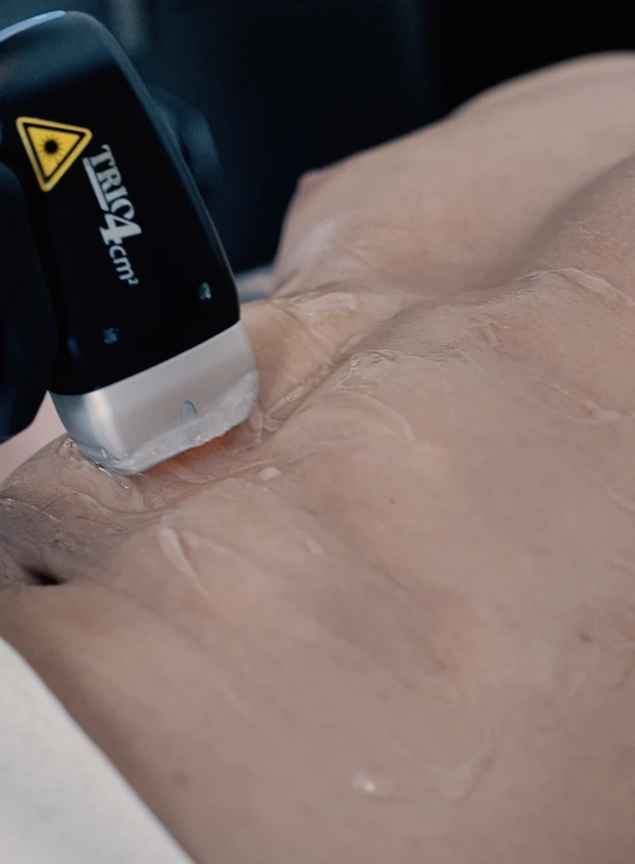 Epilation laser abdominaux homme