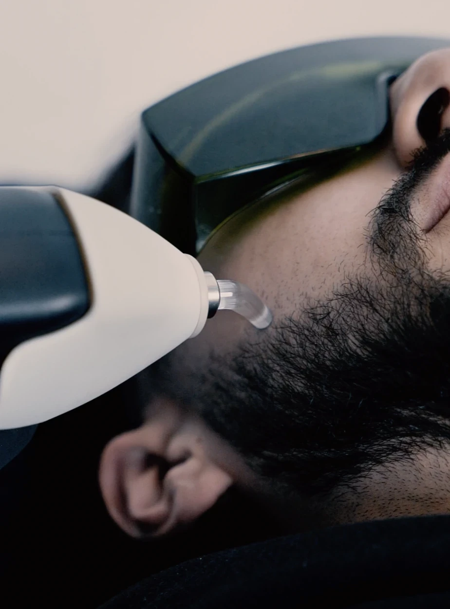 Epilation laser visage homme