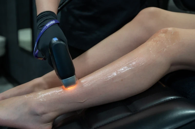 épilation laser de la jambe - Crolles