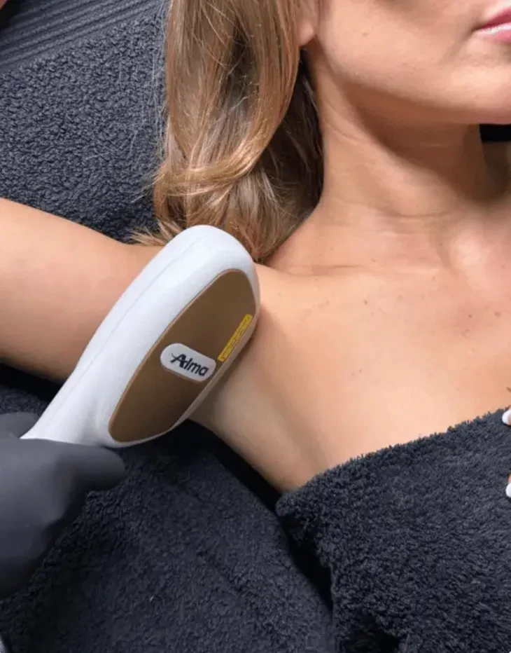 Lumière pulsée sur des aisselles