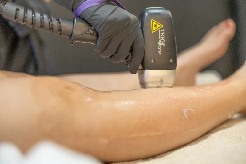 Epilation laser en été - Laser 26