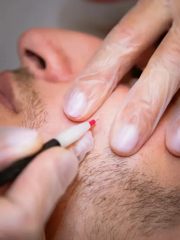 Epilation définitive Candela Gentlemax Pro Plus - laser 26